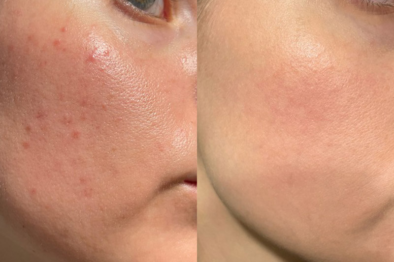 Bellevue Acne Scar Treatment