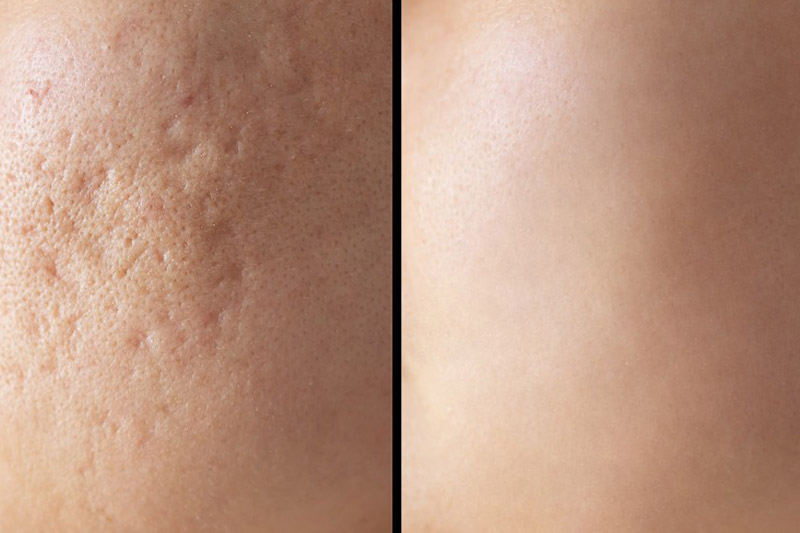 Mercer Island Acne Scar Treatment