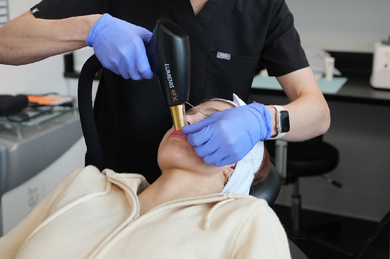 Bellevue Fractional Laser Treatment
