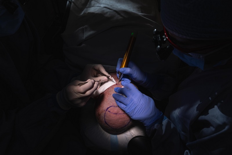 Mercer Island Hair Restoration Surgery