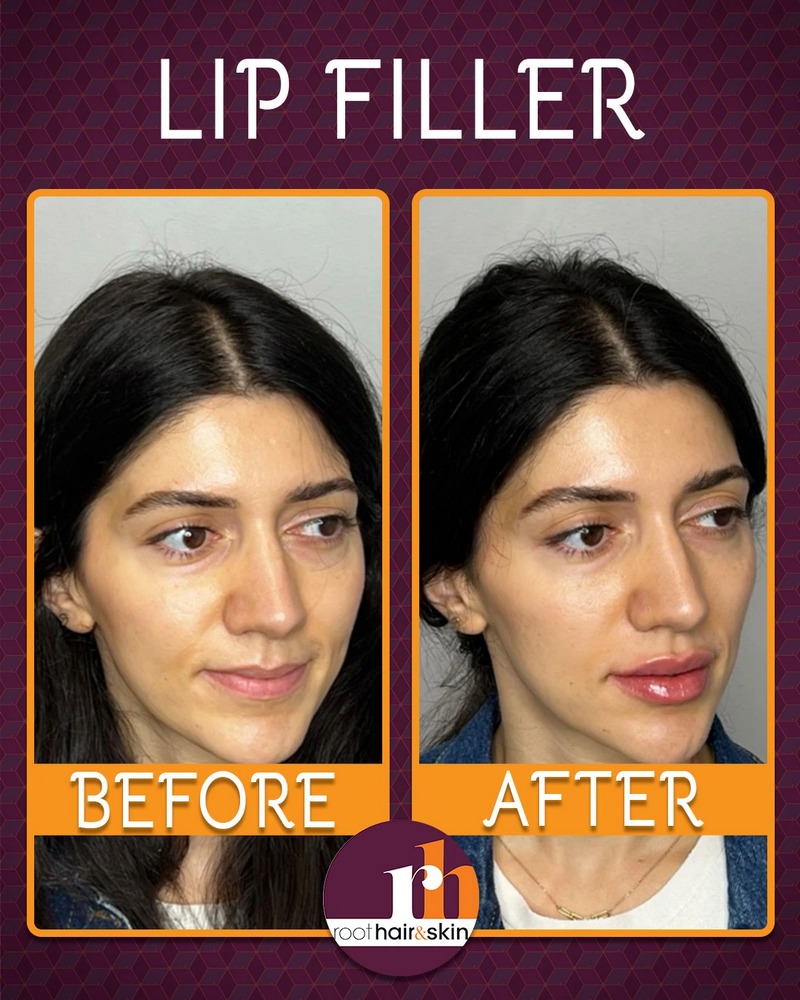 Lip B&A 2