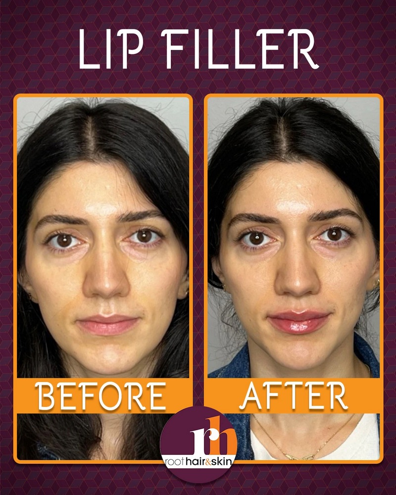 Lip B&A 3