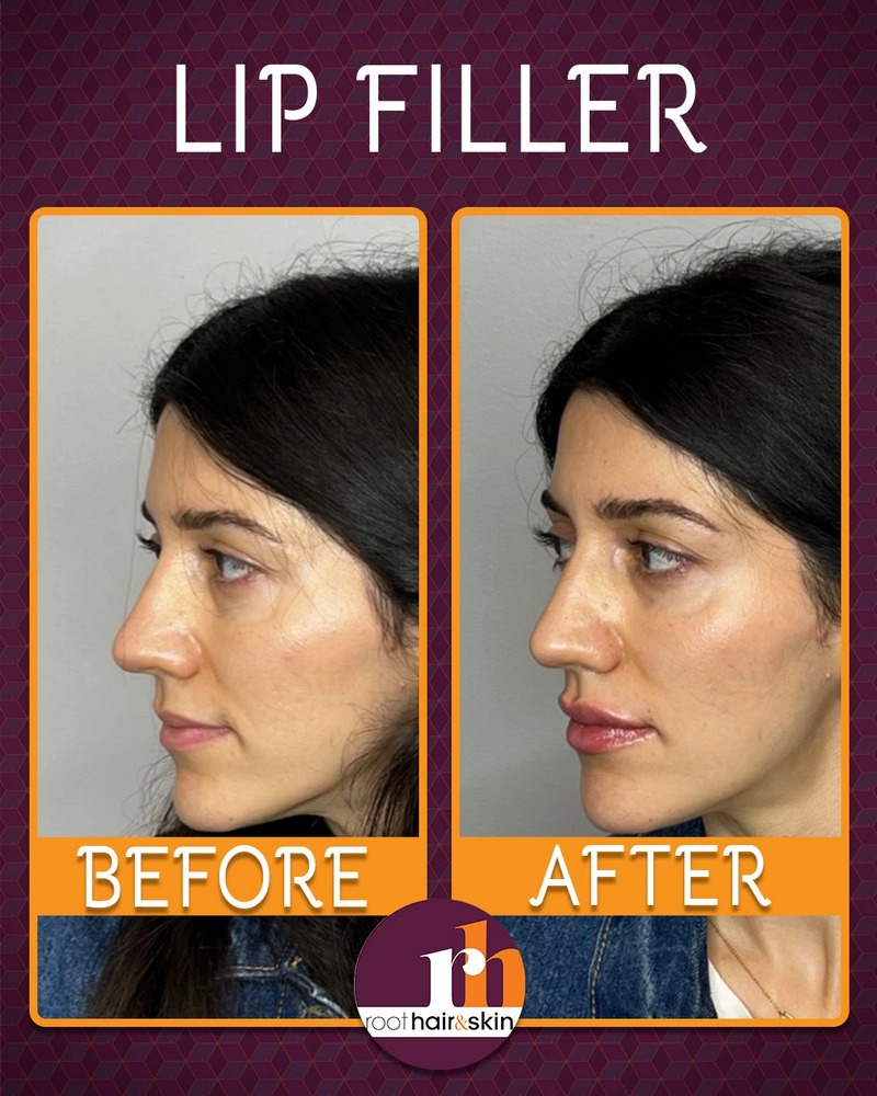 Lip B&A 5