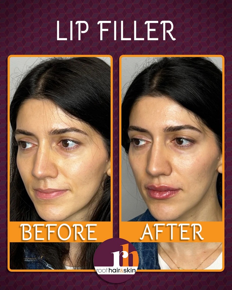 Lip B&A1