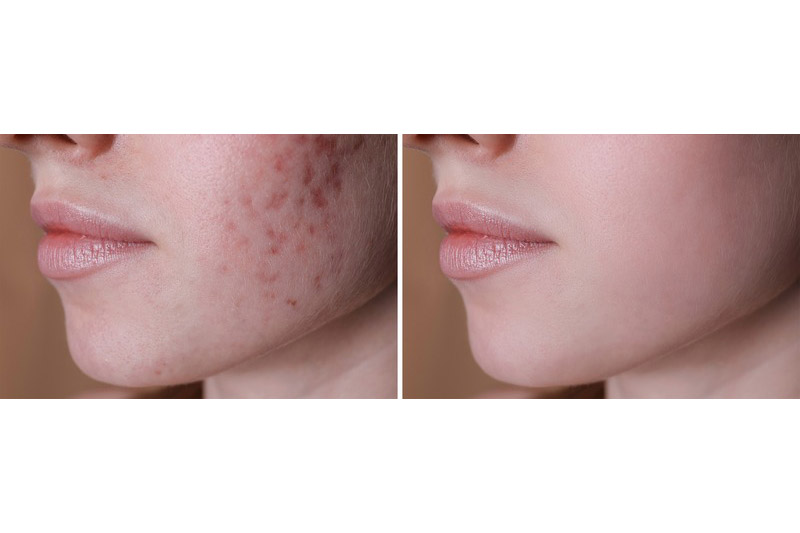 Bellevue Skin Resurfacing