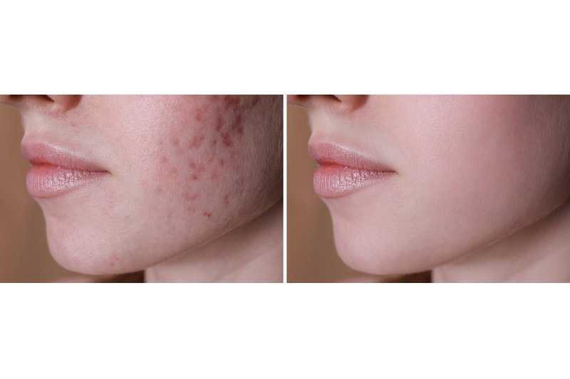Redmond Skin Resurfacing