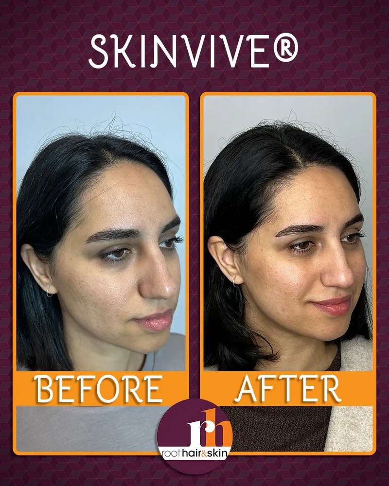 Skinvive B&A1