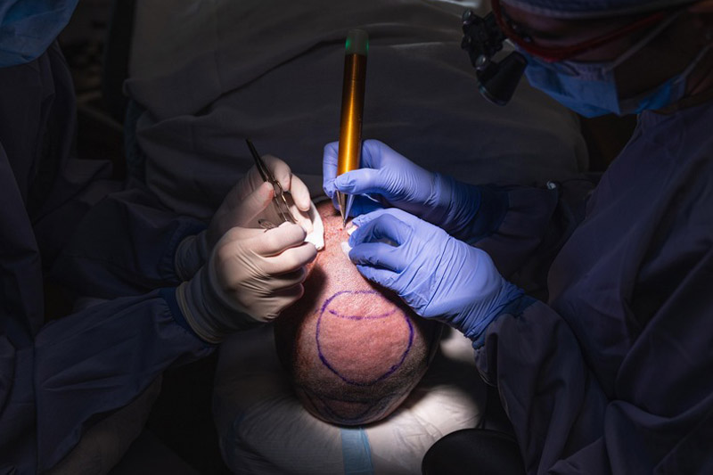Kirkland FUE Hair Transplant