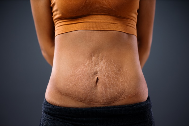 Newcastle Laser Stretch Mark Removal