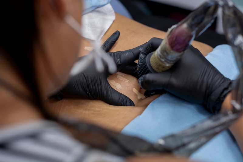 Newcastle Skin Resurfacing
