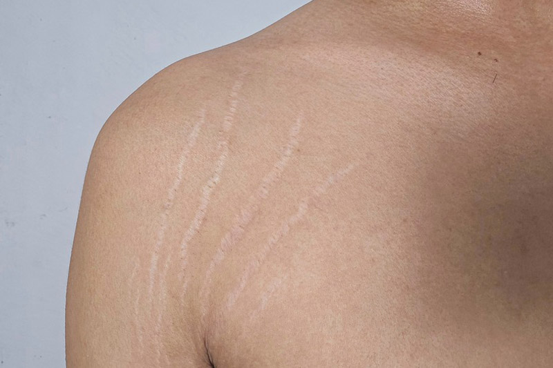 Redmond Laser Stretch Mark Removal
