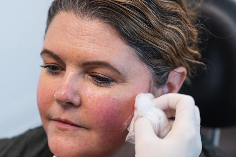 Issaquah Jawline Filler