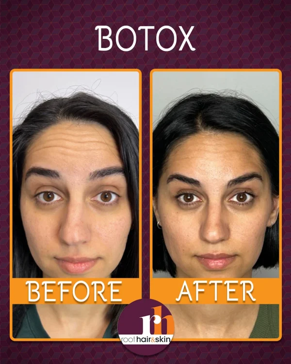 The forehead was treated to soften the expression of raising eyebrows and decrease forehead lines.